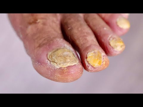 Super HIGH RISK THICK TOENAIL TRIMMING PT.2 1