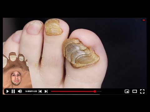 CRAZY TOENAIL SHELL?! SUPER THICK NAIL CLIPPING!!! #toebroclip 1