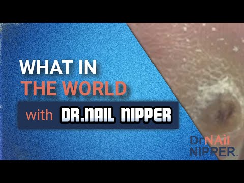 What in the world caused this callus? Where in the world is Dr Nail Nipper? (2019) #40 1