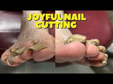 Cutting Thick, Hard To Cut Nails On 88-Year-Old Karaoke Queen! 1