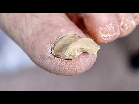 Super Thick RARE WHITE TOENAIL?! 1