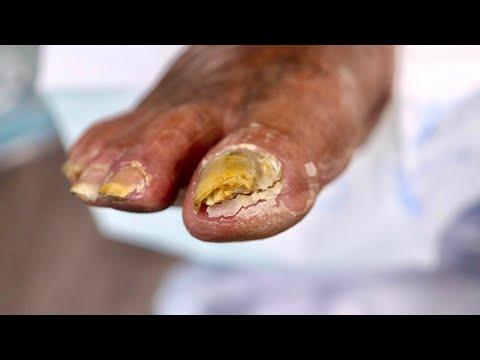 Super HIGH RISK...Super THICK TOENAIL TRIMMING 1