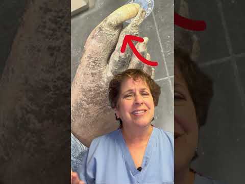 Severely Long Thick Toenails #drnailnipper #thicktoenails 1