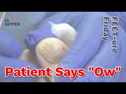 Patient Says Ow, Rhymes with Meow. Toe Pain Ouch. FEET-ure Friday (2023) 1