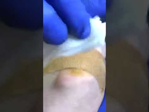 Uncovering the Criteria for Joint Surgery Reveals Surprising Findings 1