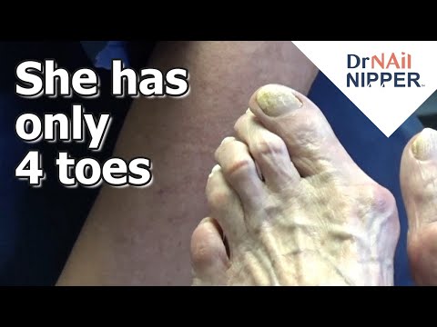 Unbelievable! She has only 4 toes. FEET-ure Friday (2023) 1