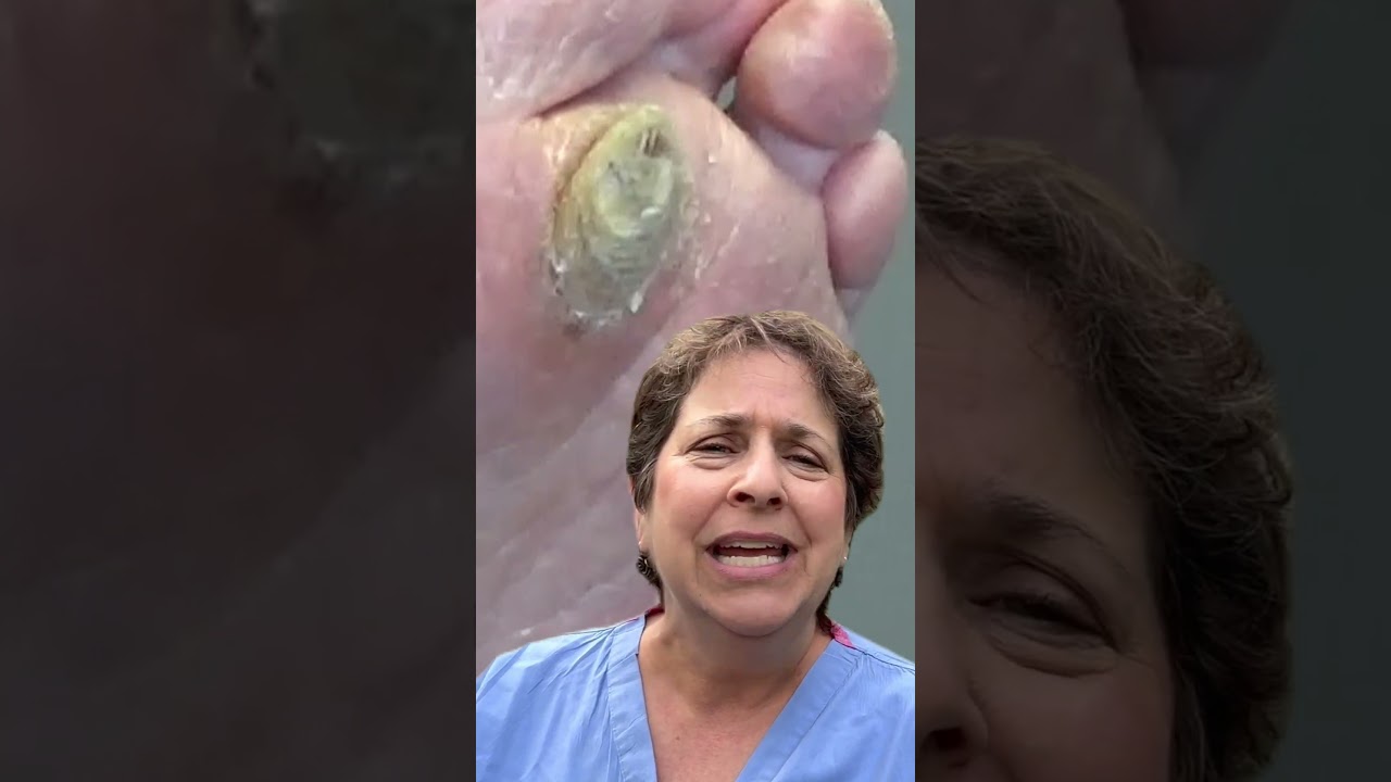 Monster Callus from First Appointment in 10 Years, Part 2 1