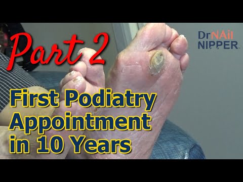 Monster Callus - First Podiatry Appointment in 10 Years, Part 2. Callus Tuesday (2023) 1