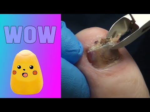 Contusion w Fungal Musical Nail 1