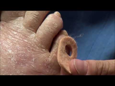 Baby Toe Corn REMOVAL! Dr. Nail Nipper! 1