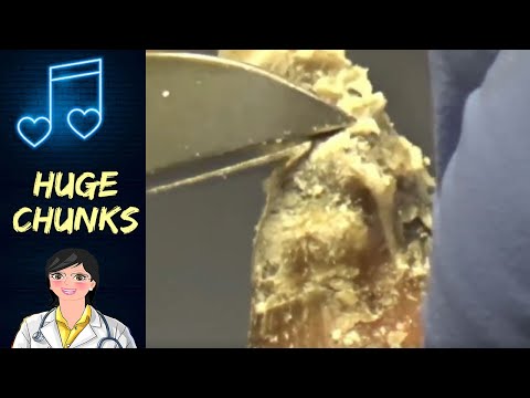 Crusty Nail Highlights 3 - Nails and Music 1