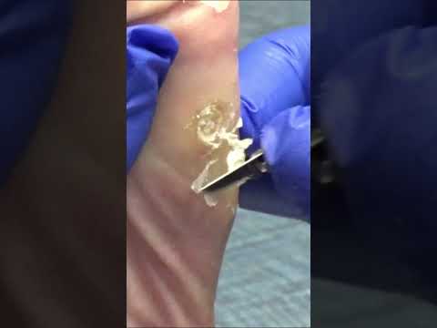 Callus Cutting by Dr Nail Nipper 1