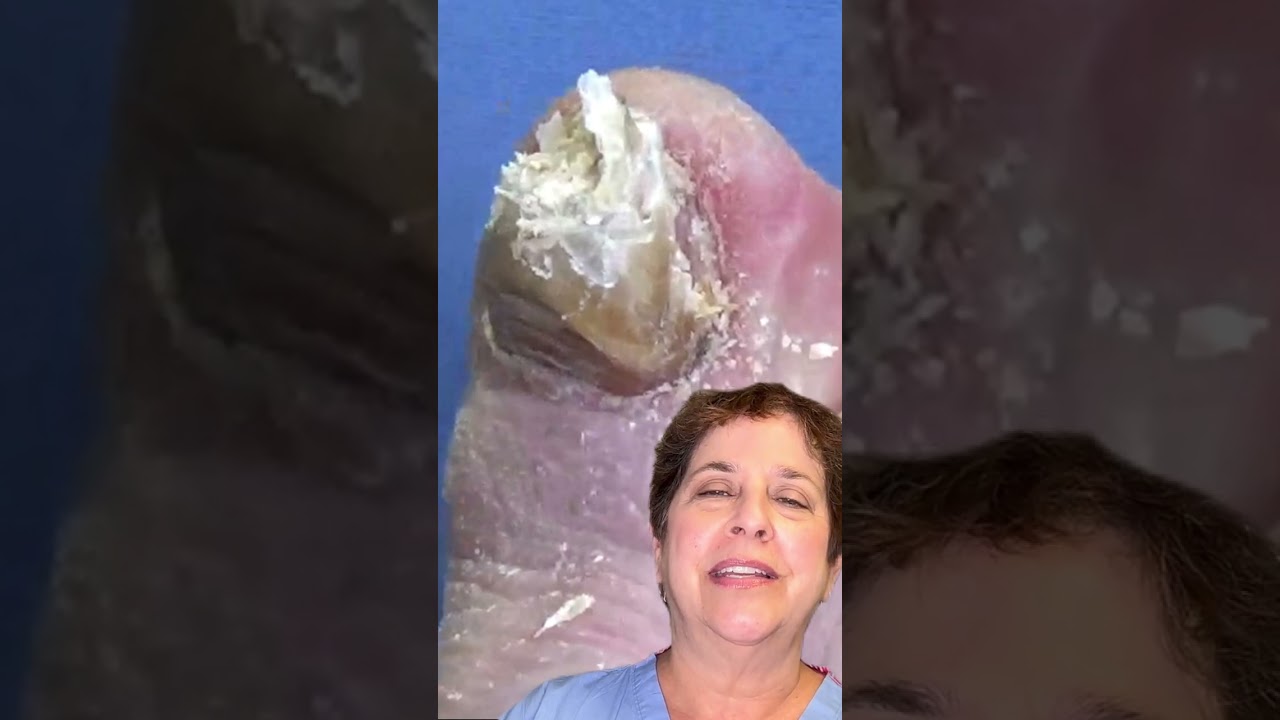 One Big Thick Toenail and One Crossover Toe - Intro 1