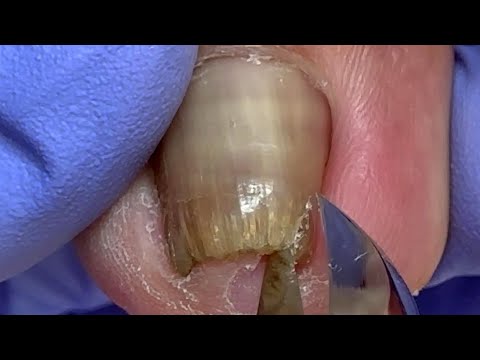 Hard nail fungus! Use large pliers to pull out embedded nails【Doctor Liu Pedicure】 1