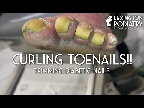 Curling Toenails! Trimming Diabetic Nails 1