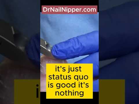 Fungal Toenail Success #drnailnipper #fungaltoenail #toenailfungus 2