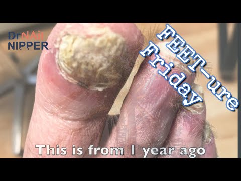 ➡️ Fungal Toenail Success. FEET-ure Friday (2023) 1