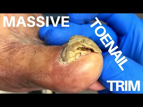 Massive Thick Toenail Trim 1