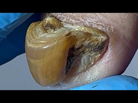 Wow~ Thick and dirty onychomycosis, how long has it been without trimming【Pedicure Master Lin Jun】 1