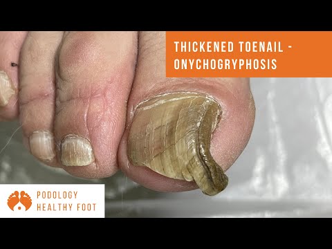 Super Thick RARE BLACK TOENAIL! in a Relaxing ASMR 1