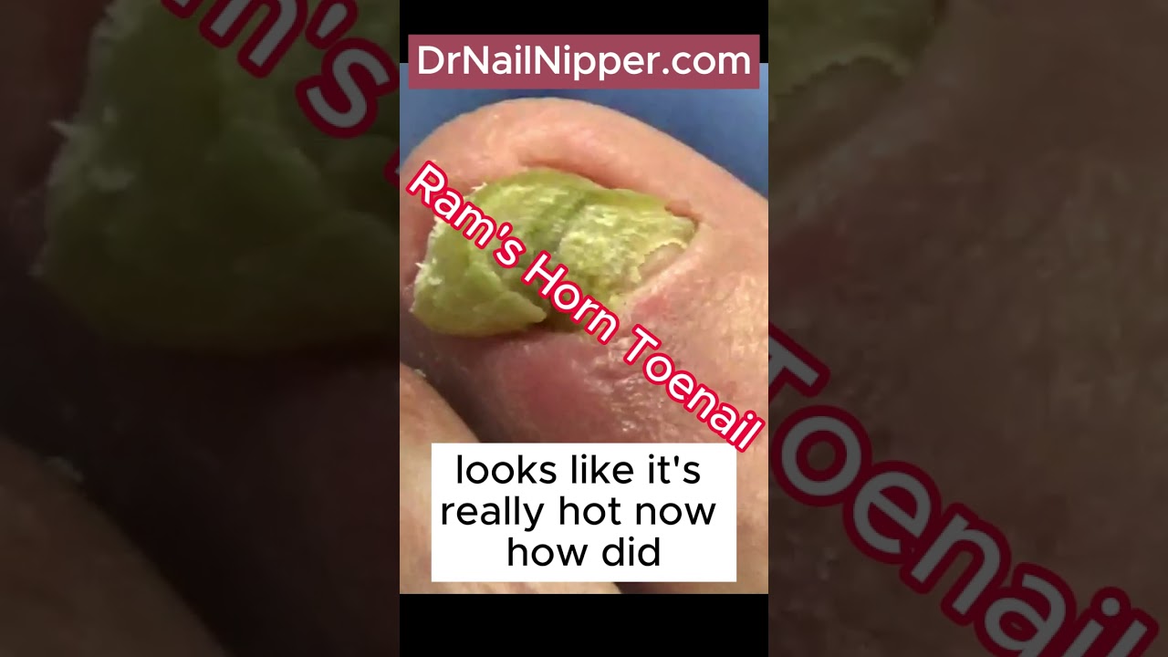 Dr Nail Nipper ➡️ Great Big Ram's Horn Nails on Big Toes #foothealth #nailnipper #drnailnipper 2