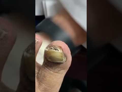 ???? CRUMBLY, FUNGUS INFECTED TOENAIL CUTTING! #shorts #nailcutting 1