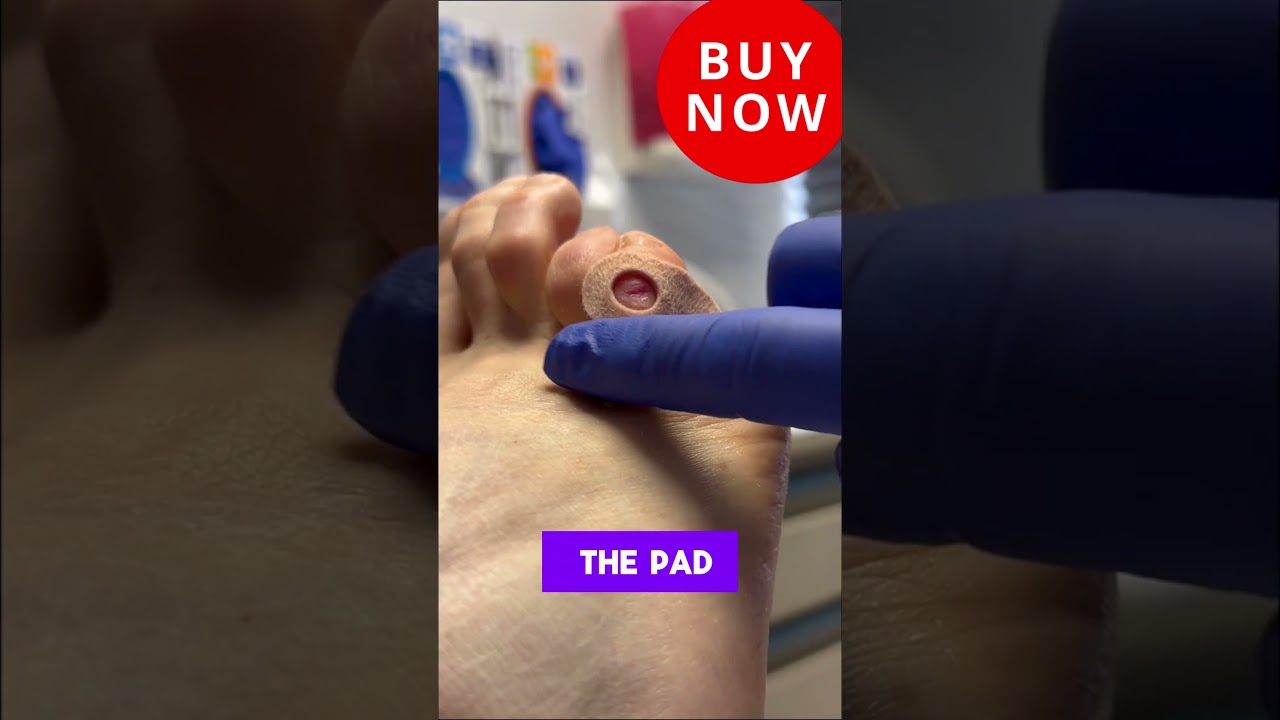 Dr Nail Nipper explainer Corn Pads #foothealth #footcare #drnailnipper #cornpads #drjillsfootpads 5