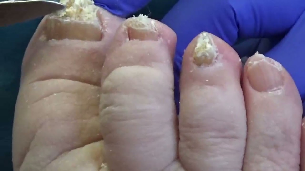 90 years old in Paris with Dr Nail Nipper 6