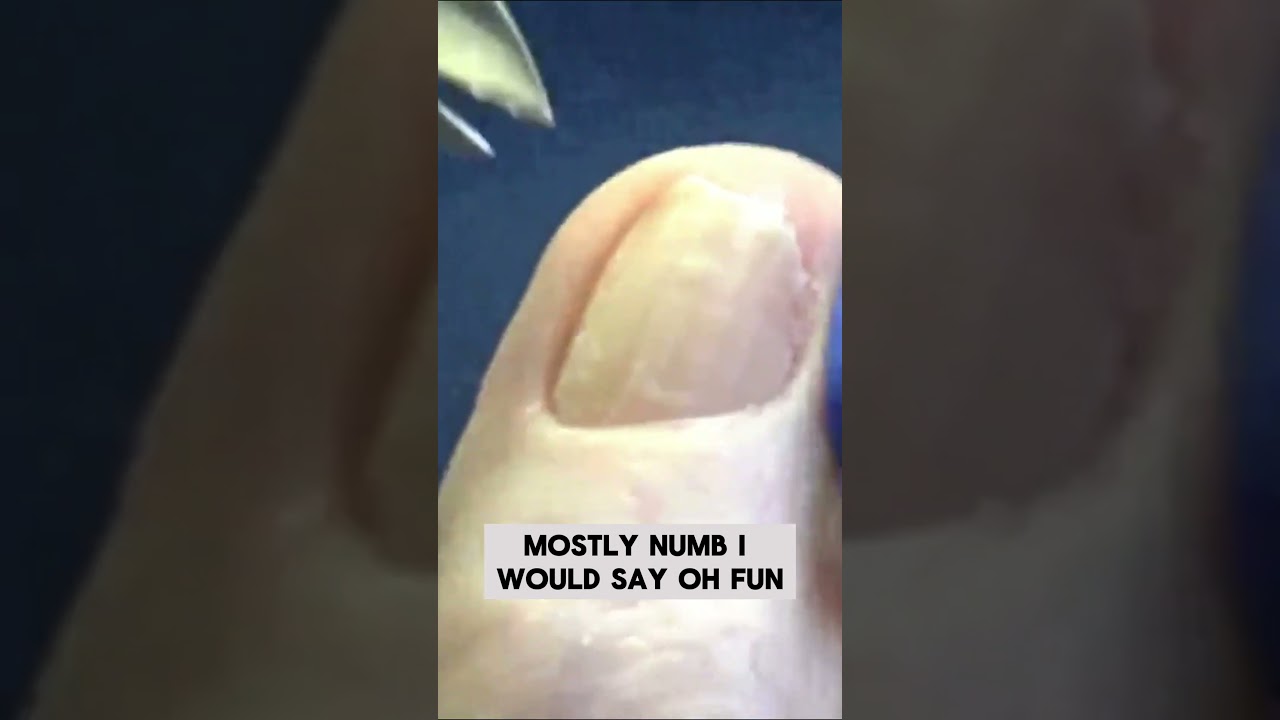 Thick Toenails and a Callus #foothealth #drnailnipper #nsaleonyoutube #thicktoenail #callus 2