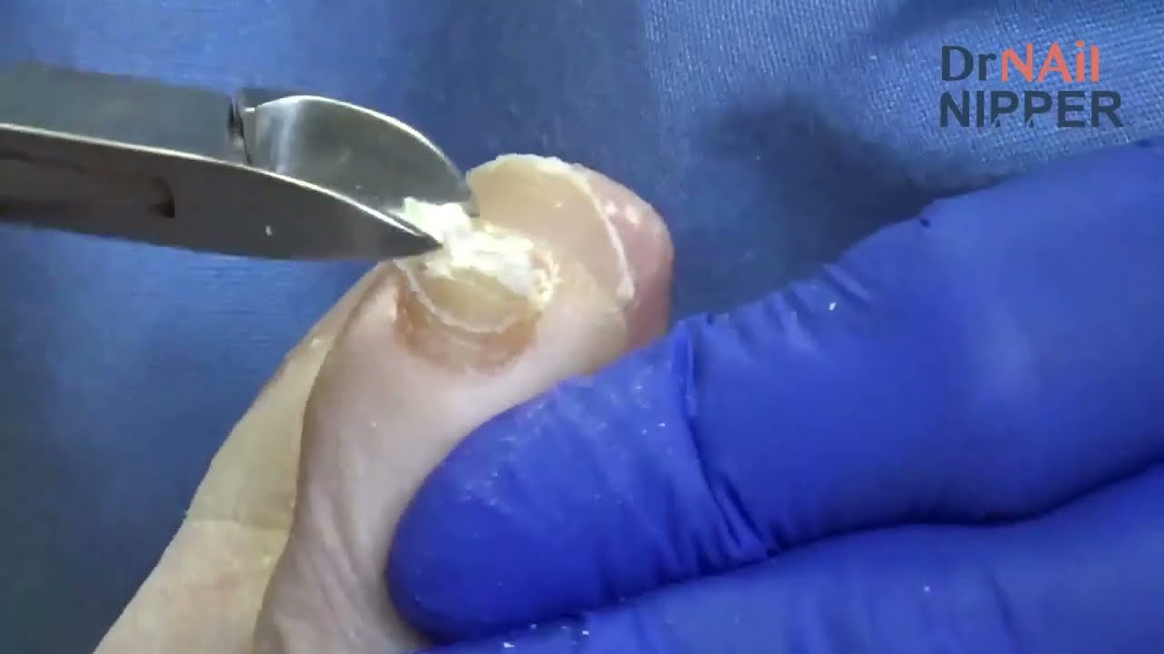 Dr Nail Nipper - Non-Intro for March 22 1