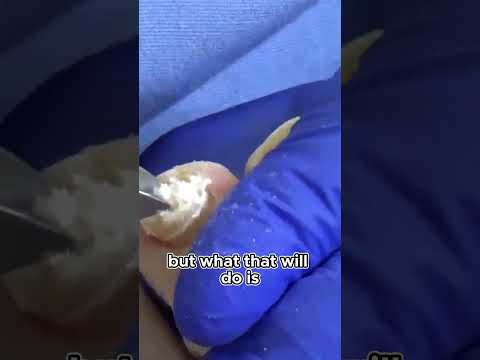 Turn Your Old Shoes Into Comfy Slip-Ons #Slip-on #foothealth #drnailnipper #footcare 1