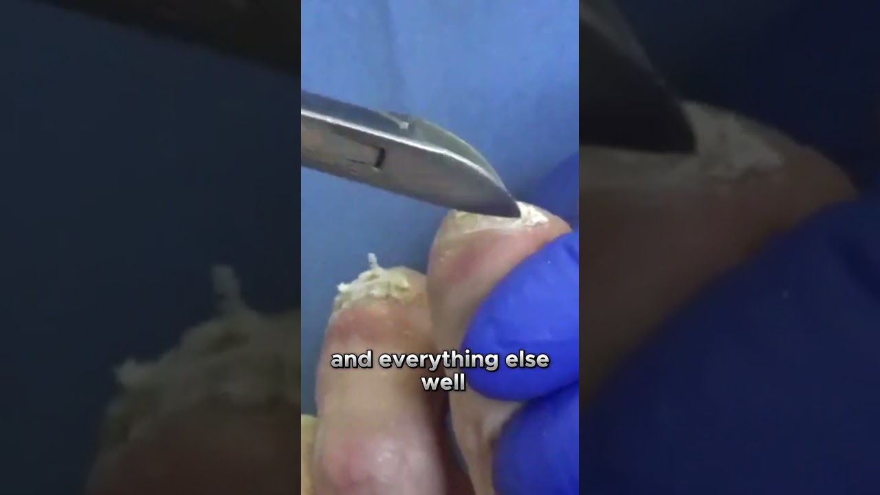 Uncertainties of Fungal ToeNail Treatment #fungaltoenail #drnailnipper 6