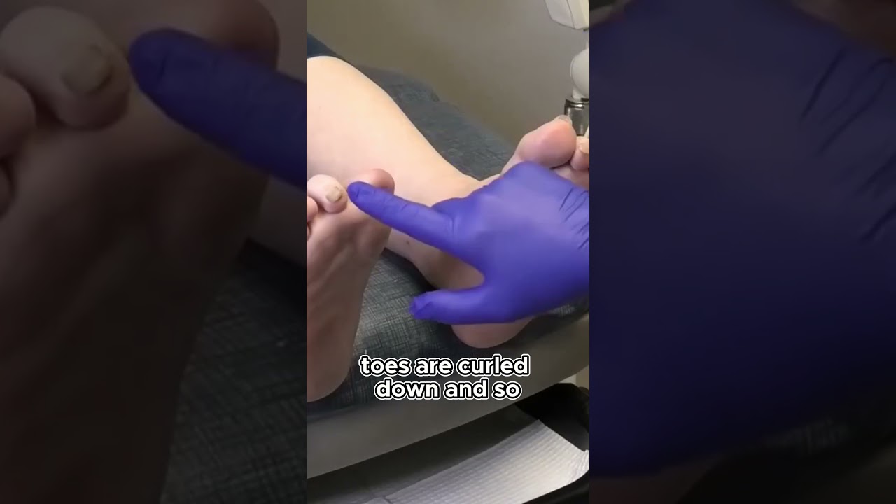 The Unusual Case of Toes with Nails on the Bottom #footcare #drnailnipper #foothealth 1