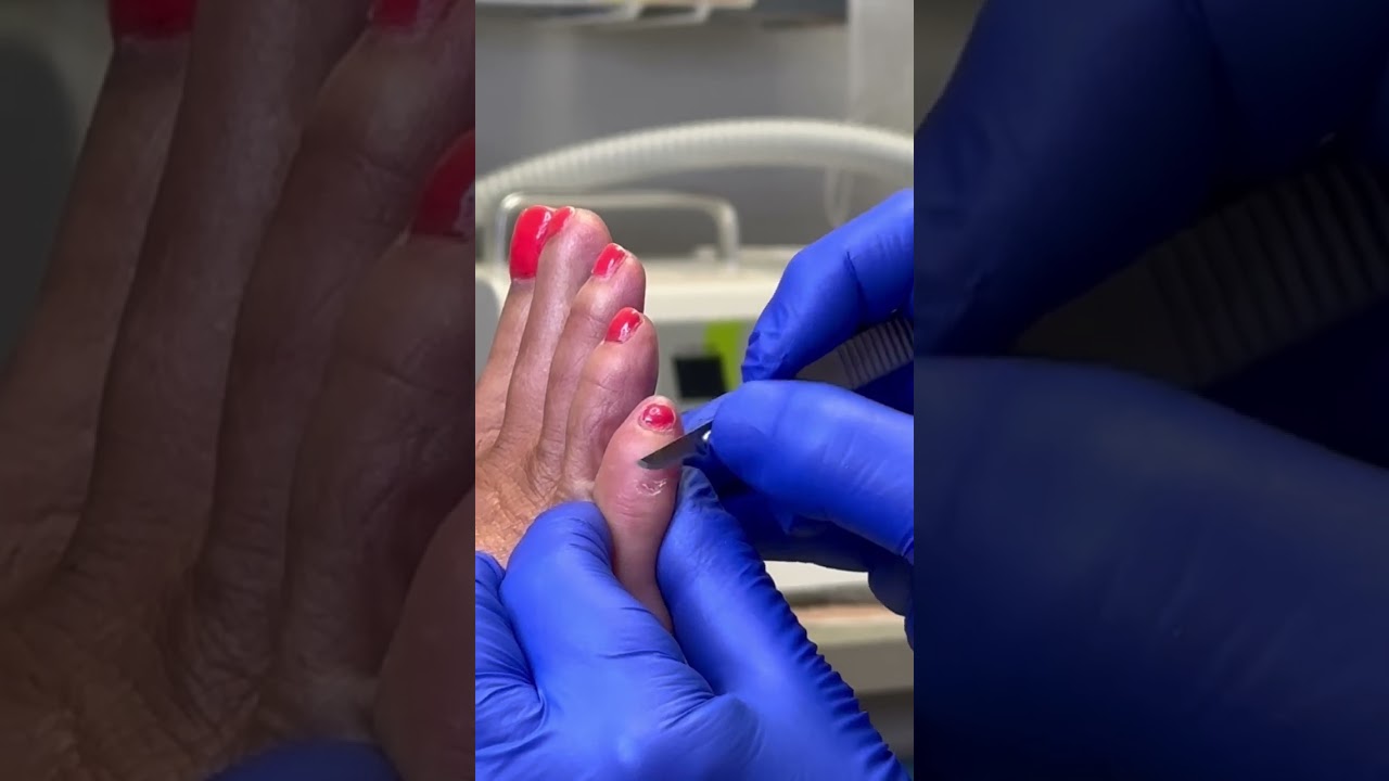 5th Toe Corn Pad ... and debridement | Part 1 1