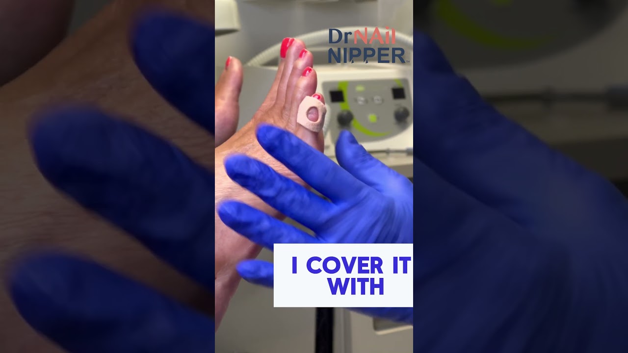 5th Toe Corn Pad ... and debridement | Part 2 #CornPad #Debridement #drnailnipper 1