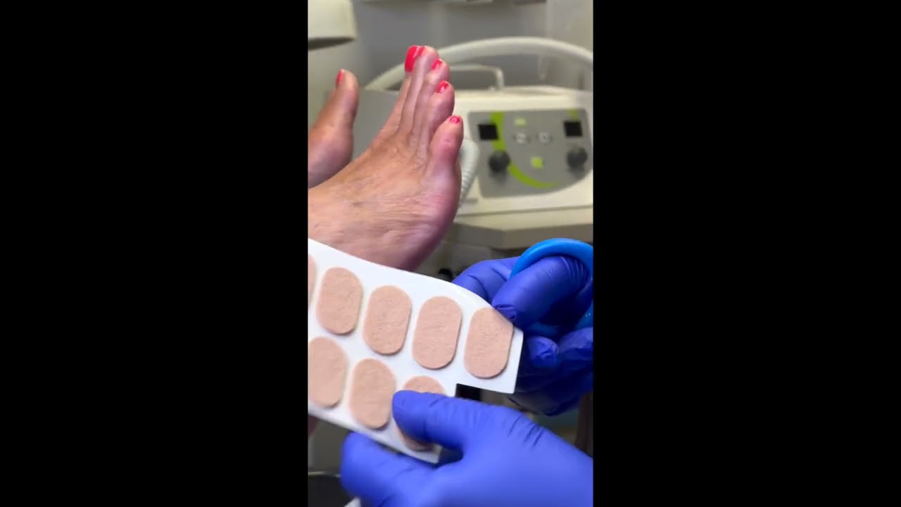 5th toe corn pad and debridement - short #debridement #toecornpad 1