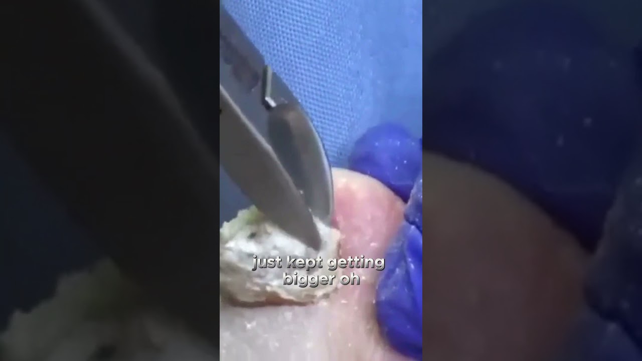 From Bruise to Diagnosis The Path to Discovery #foothealth #podiatry #drnailnipper 1