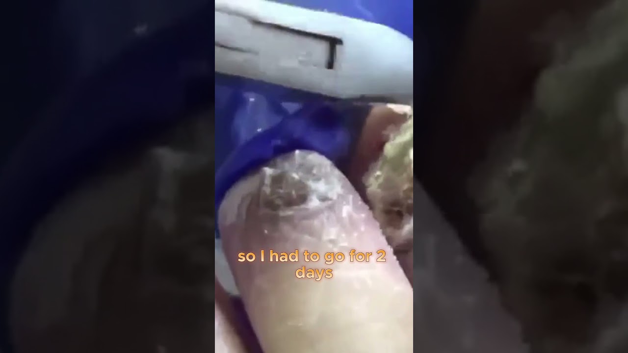 The Road to Recovery Chemotherapy and Hospital #drnailnipper #foothealth #podiatry #footcare 1