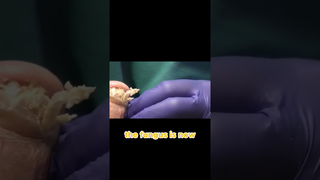 Is Your Toenail Fungus Really Fungal Here's 1