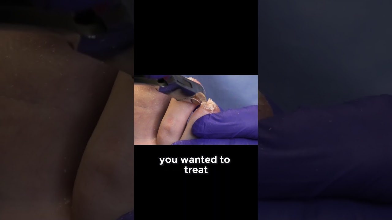 Dealing with Toenail Fungus Treatment Option 1