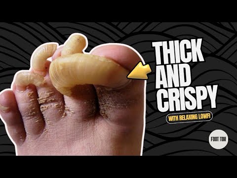 DOUBLE Rams Head Toenail Cut With Relaxing Low Fi | Featuring Lexington Podiatry 1