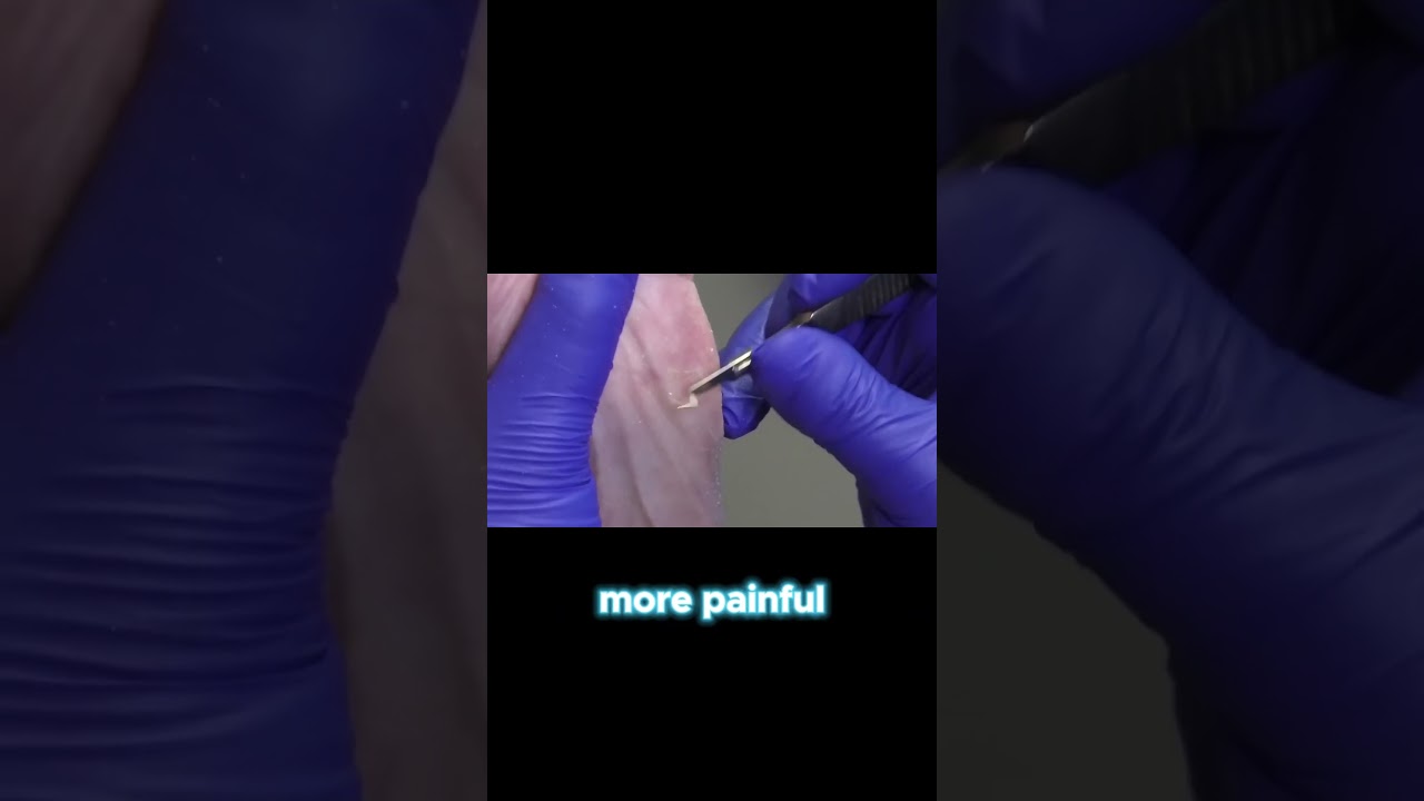 Which Callus Hurts More Left or Right 1