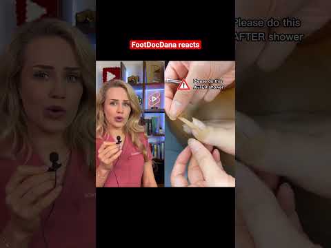Doctor reacts: ingrown nail stickers?! 1