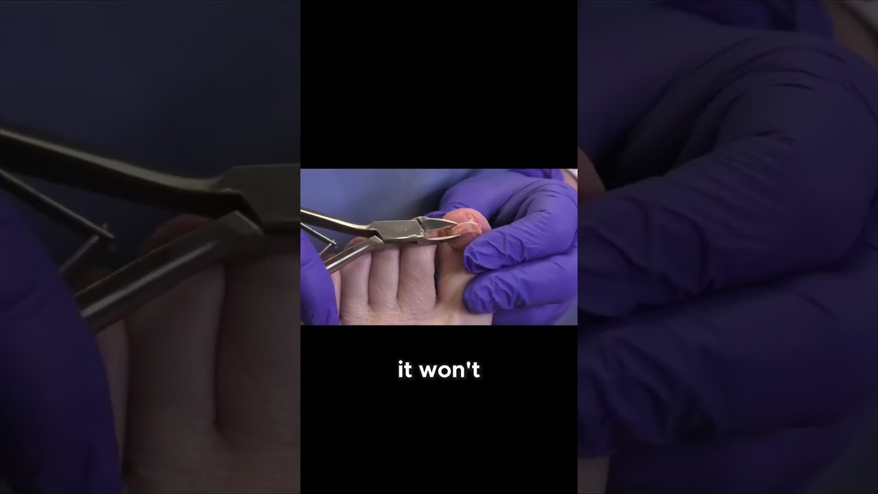 Struggling with ingrown nails? #IngrownNails #NailCareTips #FootHealth 5