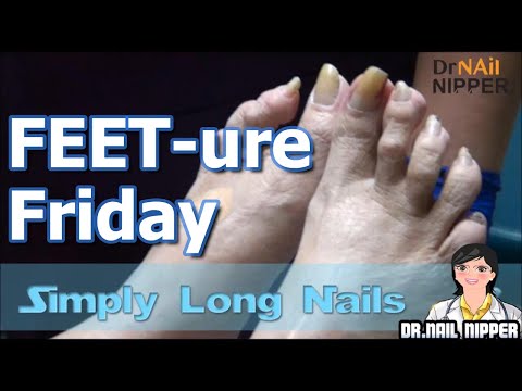 Long Toenails | FEET-ure Friday - Dr Nail Nipper (2024) 1