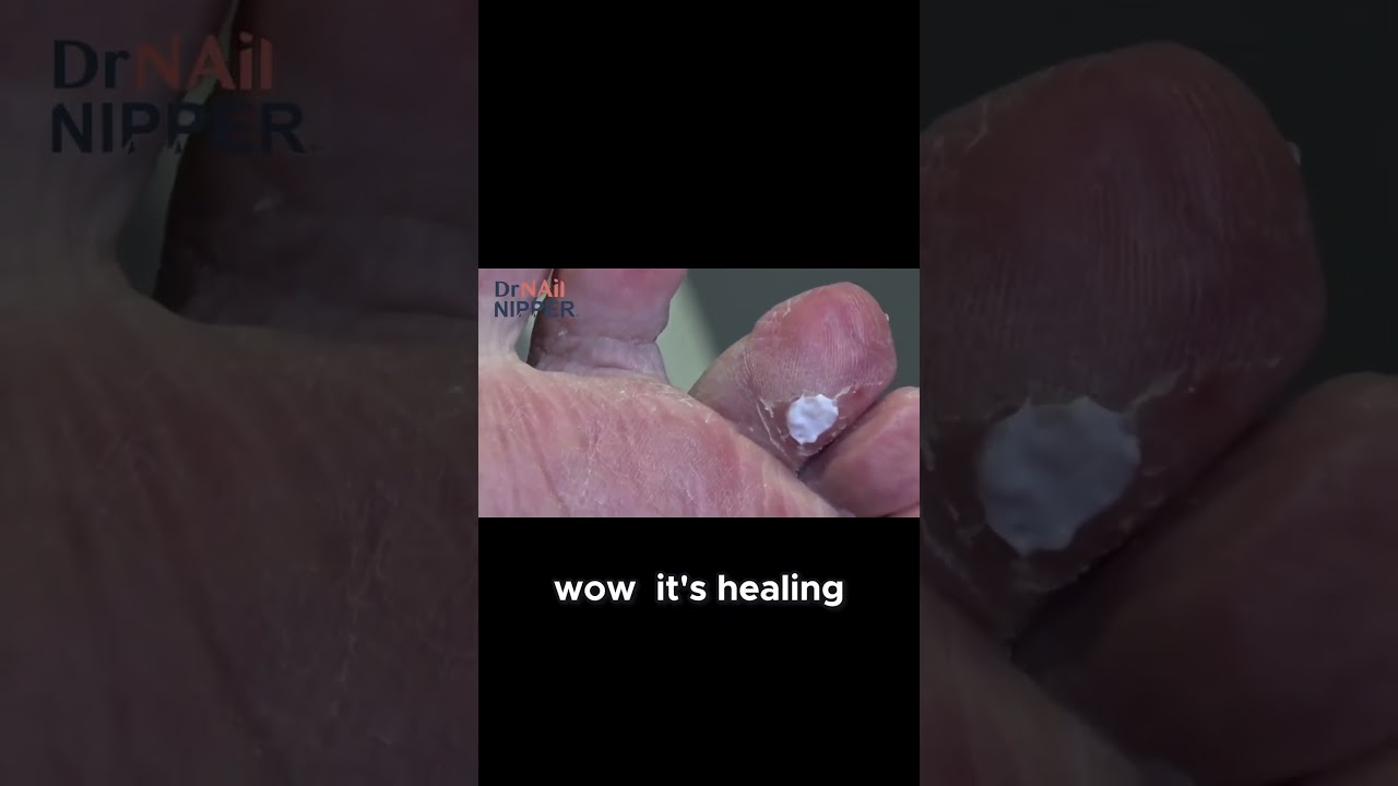 Healing an Open Wound Under a Callus #callus #openwound #healing 3