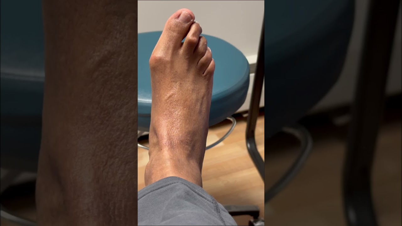 Hammertoe Splint Short #hammertoes #toesperandonosenhor #toenailcare 4