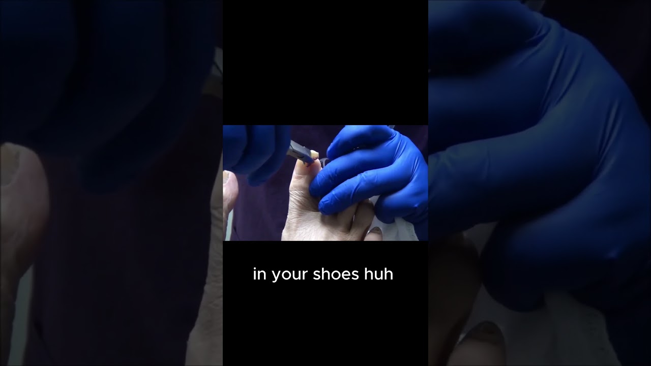 Ever wondered why your toes hurt in shoes? #FootPain #ToenailProblems #ShoeInserts 5