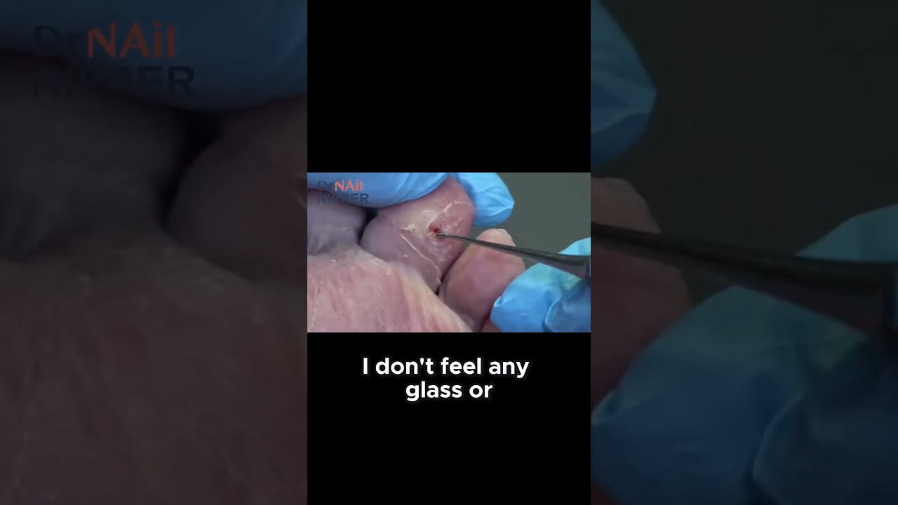 The treatment plan for an open sore under a callus! #HealthCare #MedicalTreatment #healingjourney 6
