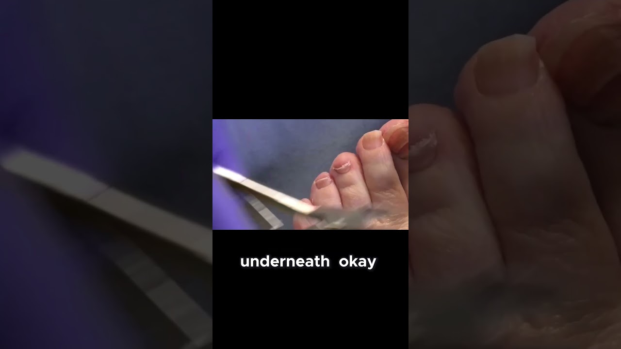 Discover the intriguing reason behind double nails on toes! #DoubleNails #FootHealth #NailCare 2